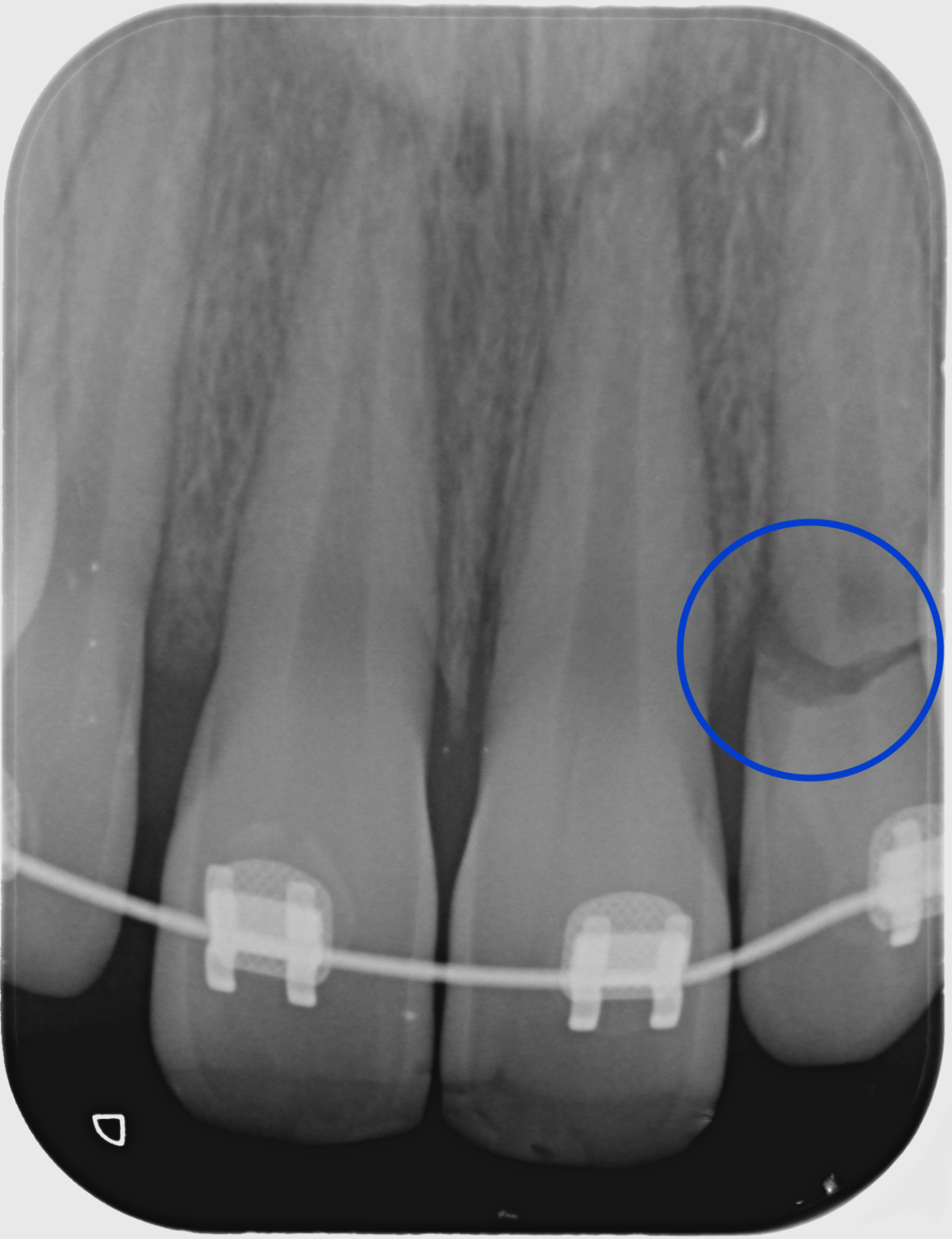 Why do we take xrays? Norwest Paediatric Dentistry