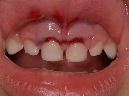 Dental trauma showing bumped teeth with red bruised gums and swelling.