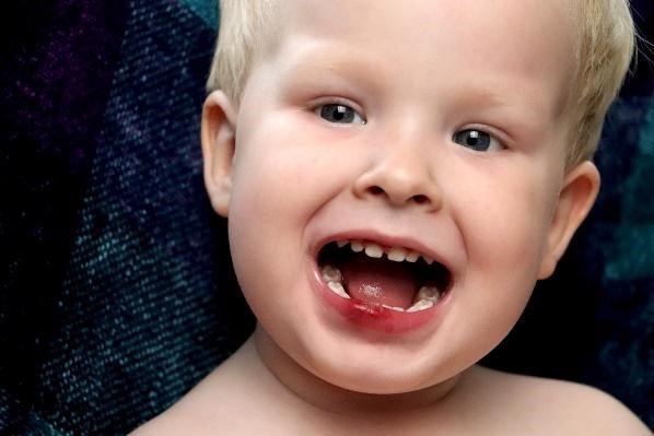 Toddler with moth open to check for bumped teeth injuries