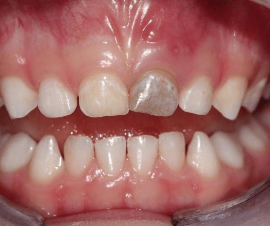 Bumped tooth that is discoloured with black circle around raised pimple on gums.